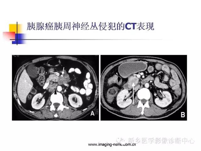 【PPT】胰腺癌侵犯周围神经丛的CT和MRI表现