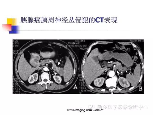 【PPT】胰腺癌侵犯周围神经丛的CT和MRI表现