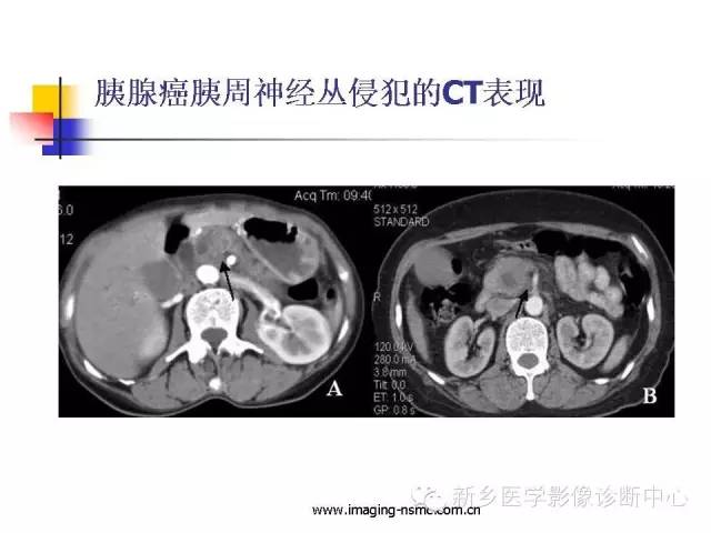 【PPT】胰腺癌侵犯周围神经丛的CT和MRI表现