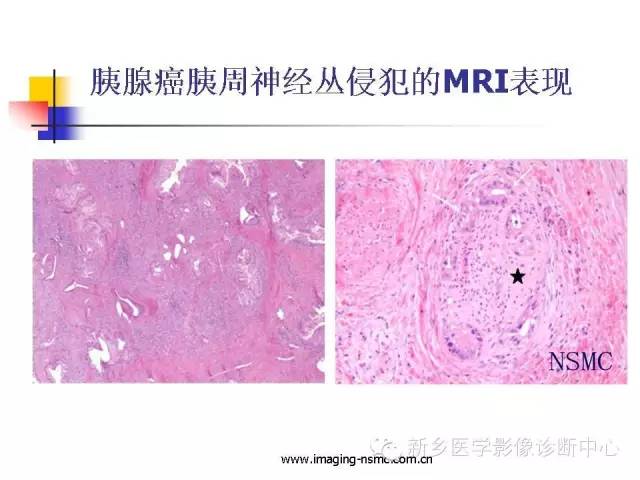 【PPT】胰腺癌侵犯周围神经丛的CT和MRI表现