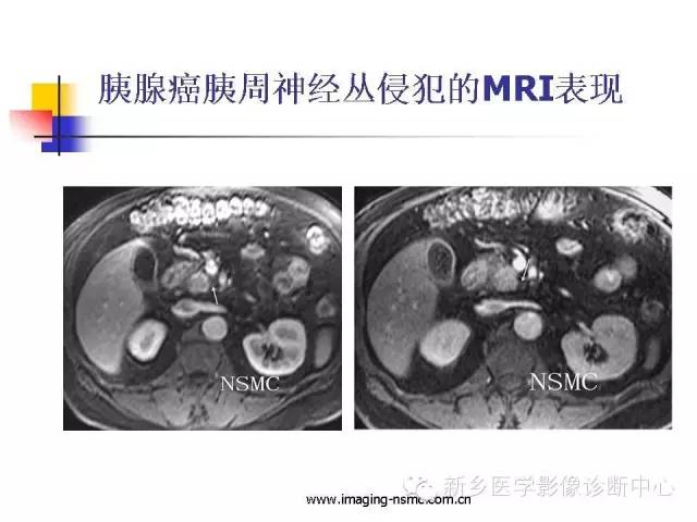 【PPT】胰腺癌侵犯周围神经丛的CT和MRI表现