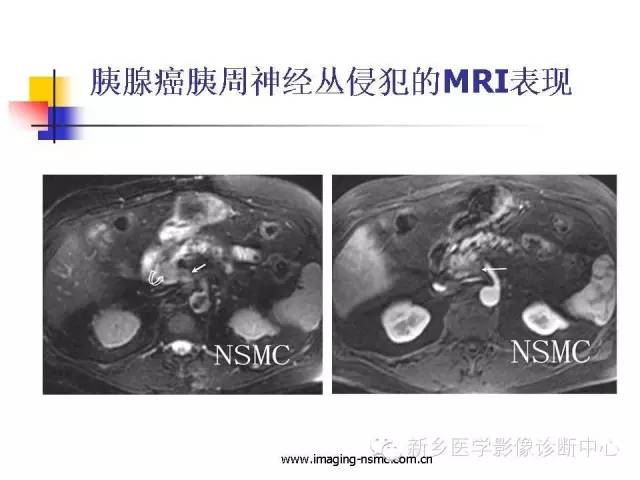 【PPT】胰腺癌侵犯周围神经丛的CT和MRI表现