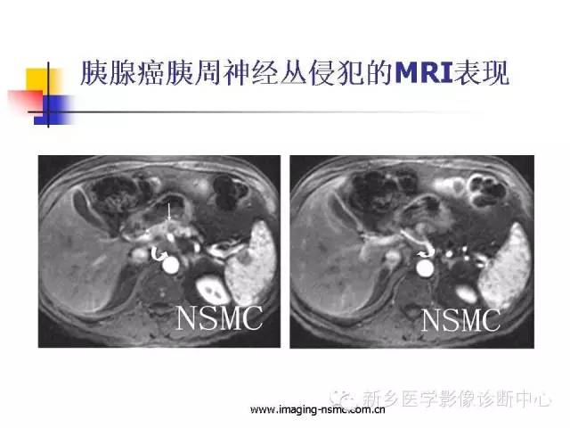 【PPT】胰腺癌侵犯周围神经丛的CT和MRI表现
