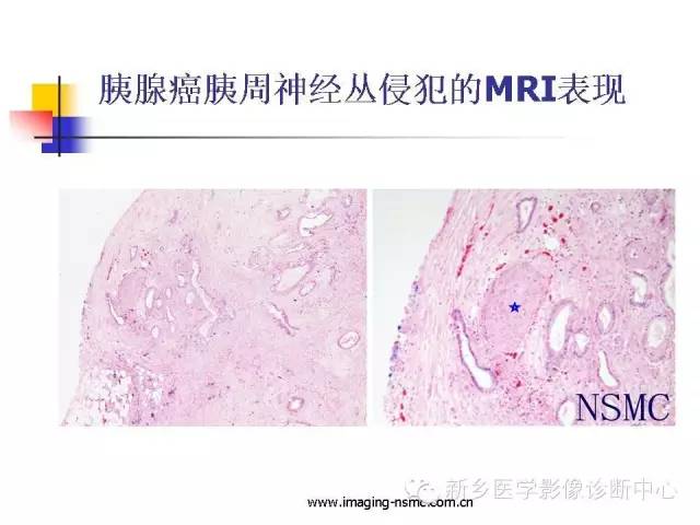 【PPT】胰腺癌侵犯周围神经丛的CT和MRI表现