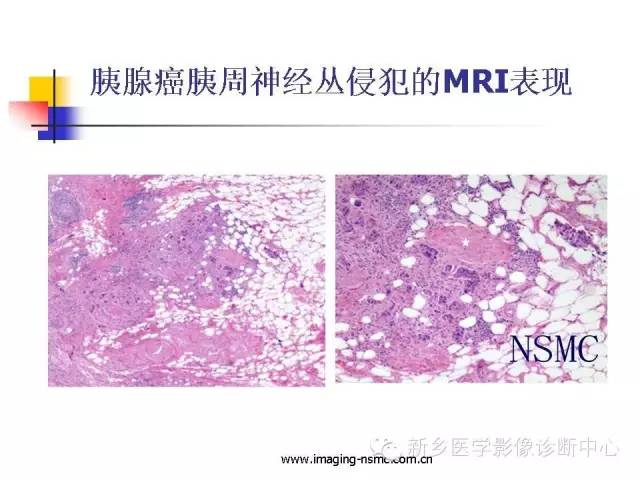 【PPT】胰腺癌侵犯周围神经丛的CT和MRI表现