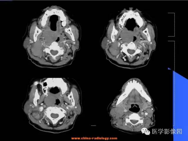 【病例】扁桃体淋巴瘤1例CT影像表现与鉴别