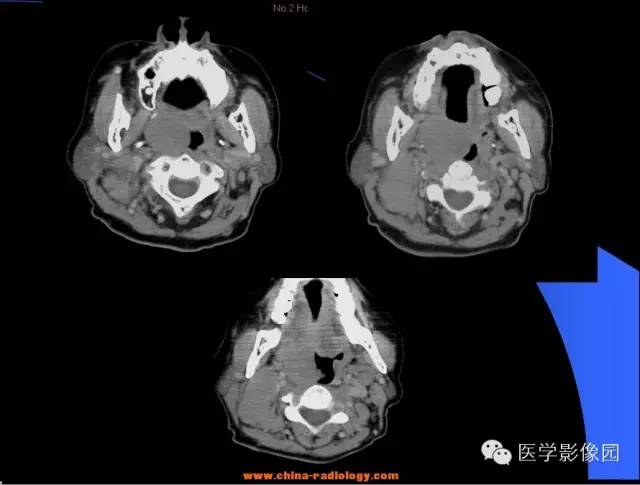 【病例】扁桃体淋巴瘤1例CT影像表现与鉴别