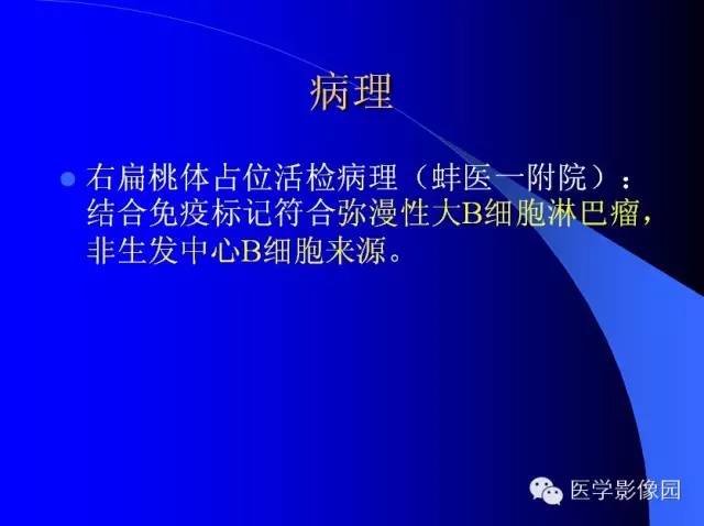 【病例】扁桃体淋巴瘤1例CT影像表现与鉴别