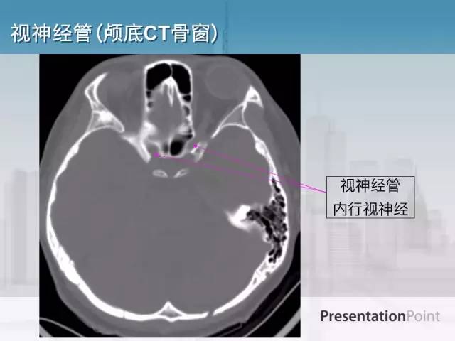 【PPT】鼻咽癌靶区勾画的相关解剖——颅底诸孔