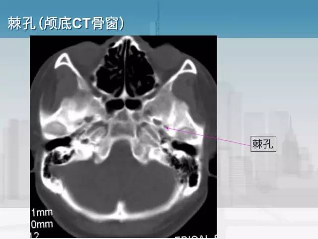 【PPT】鼻咽癌靶区勾画的相关解剖——颅底诸孔