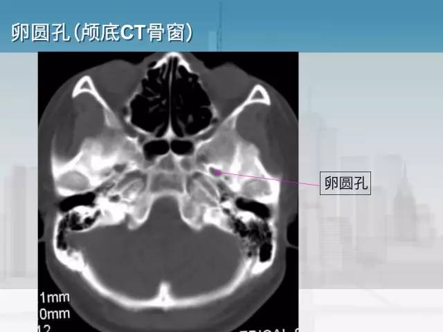 【PPT】鼻咽癌靶区勾画的相关解剖——颅底诸孔