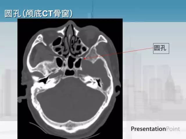 【PPT】鼻咽癌靶区勾画的相关解剖——颅底诸孔