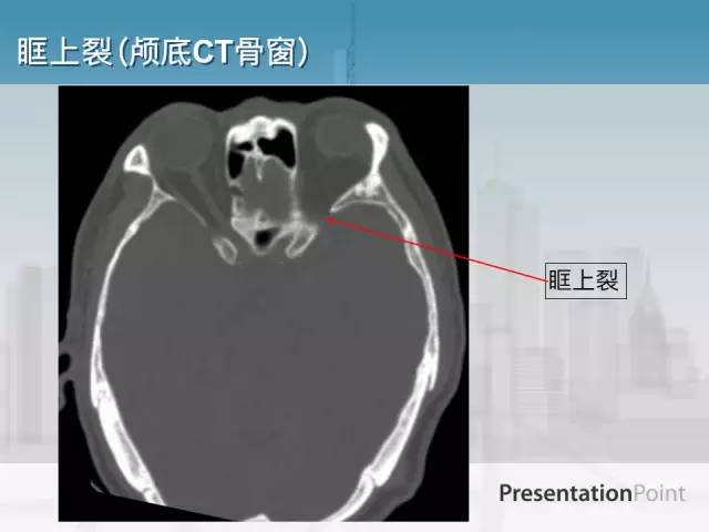 【PPT】鼻咽癌靶区勾画的相关解剖——颅底诸孔