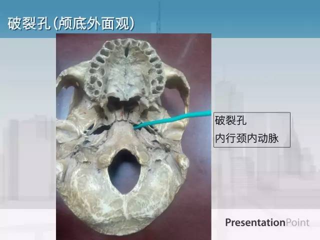 【PPT】鼻咽癌靶区勾画的相关解剖——颅底诸孔
