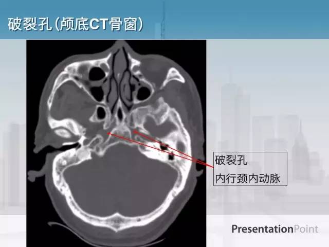 【PPT】鼻咽癌靶区勾画的相关解剖——颅底诸孔