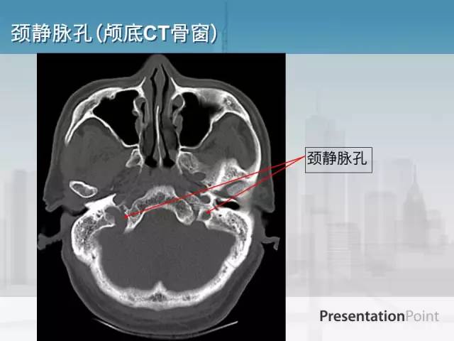 【PPT】鼻咽癌靶区勾画的相关解剖——颅底诸孔