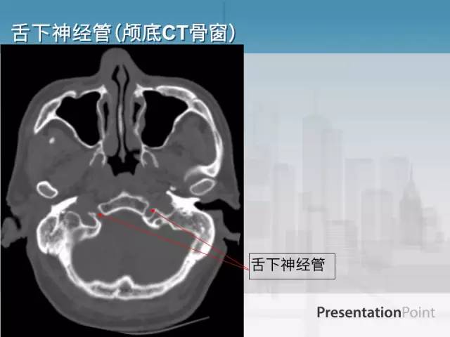 【PPT】鼻咽癌靶区勾画的相关解剖——颅底诸孔