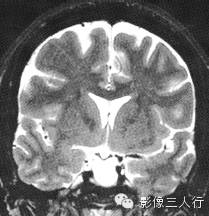 鞍区常见囊性病变的鉴别诊断 鞍区常见囊性病变的鉴别诊断