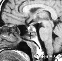 鞍区常见囊性病变的鉴别诊断 鞍区常见囊性病变的鉴别诊断