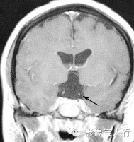 鞍区常见囊性病变的鉴别诊断 鞍区常见囊性病变的鉴别诊断