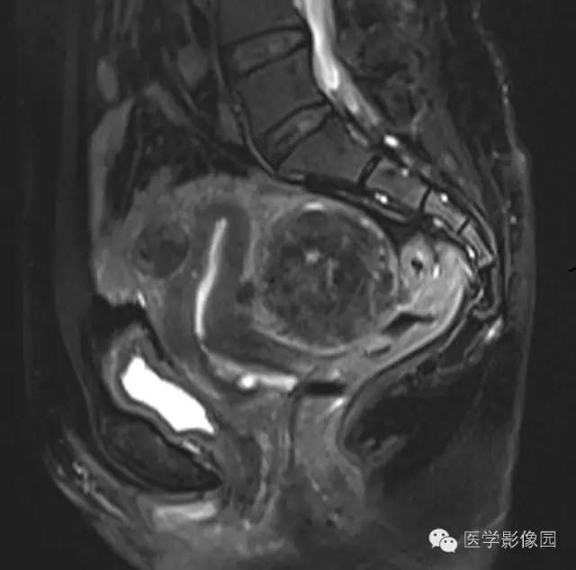 【病例】子宫多发肌瘤1例MR影像表现