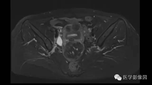 【病例】子宫多发肌瘤1例MR影像表现