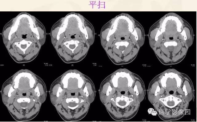 【病例】腮腺腺泡细胞癌1例CT影像表现