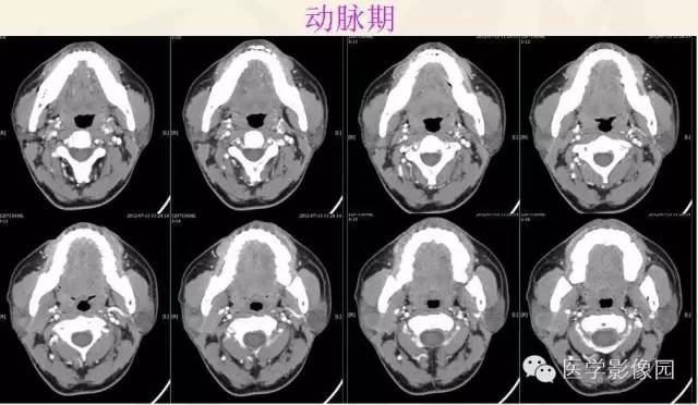 【病例】腮腺腺泡细胞癌1例CT影像表现