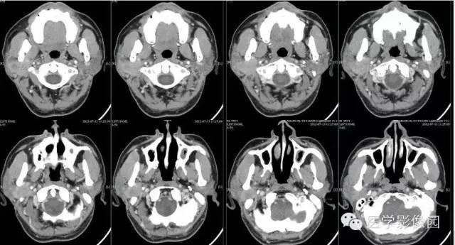 【病例】腮腺腺泡细胞癌1例CT影像表现