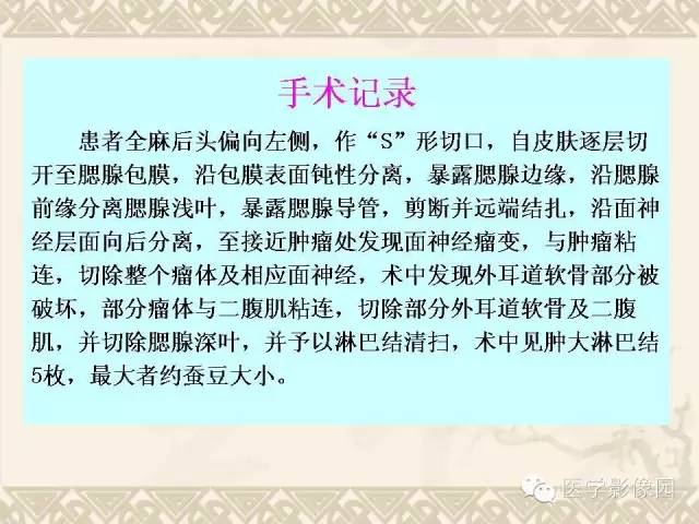 【病例】腮腺腺泡细胞癌1例CT影像表现