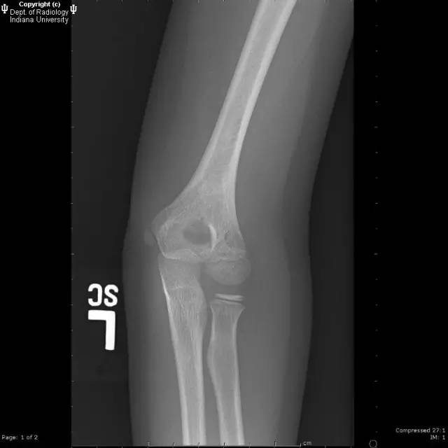 【病例】肱骨髁上突1例X线影像表现 【病例】肱骨髁上突1例X线影像表现