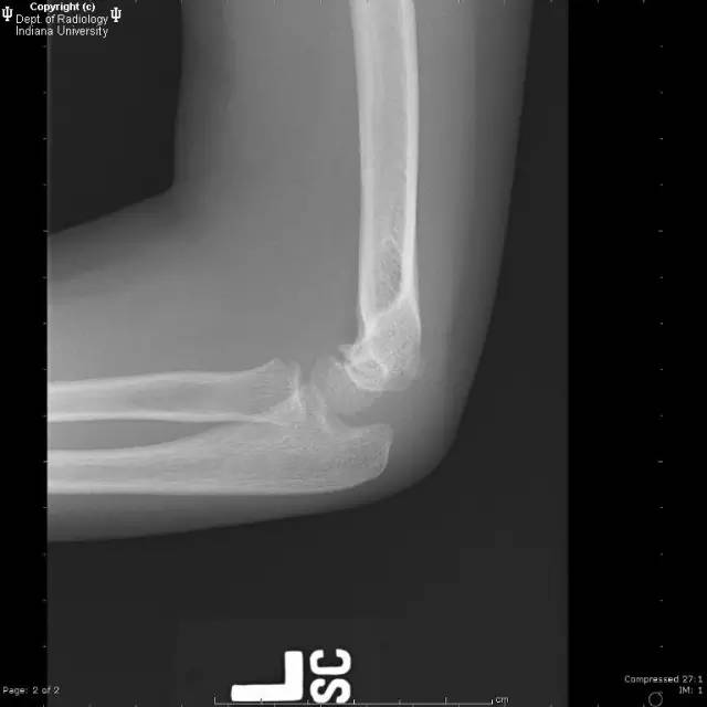 【病例】肱骨髁上突1例X线影像表现 【病例】肱骨髁上突1例X线影像表现