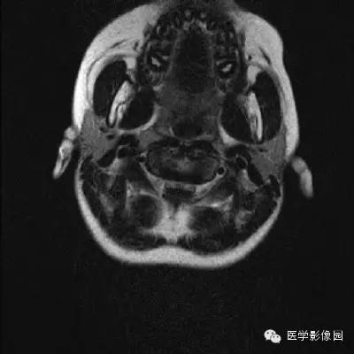【病例】齿状突游离1例影像表现 【病例】齿状突游离1例影像表现