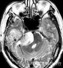 颈静脉孔区疾病的鉴别诊断 颈静脉孔区疾病的鉴别诊断