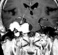 颈静脉孔区疾病的鉴别诊断 颈静脉孔区疾病的鉴别诊断