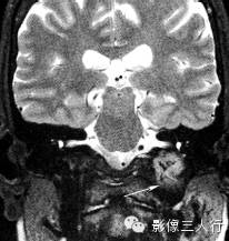 颈静脉孔区疾病的鉴别诊断 颈静脉孔区疾病的鉴别诊断