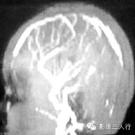 颈静脉孔区疾病的鉴别诊断 颈静脉孔区疾病的鉴别诊断