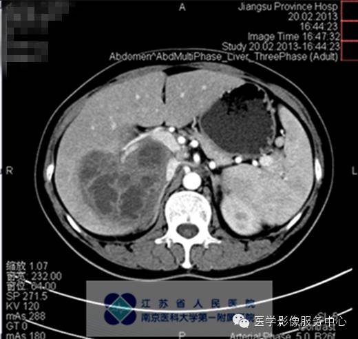 【病例】肝脓肿1例CT影像表现 【病例】肝脓肿1例CT影像表现