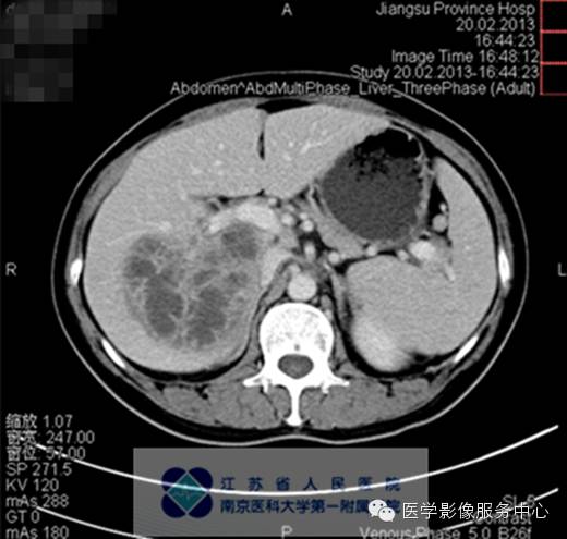 【病例】肝脓肿1例CT影像表现 【病例】肝脓肿1例CT影像表现