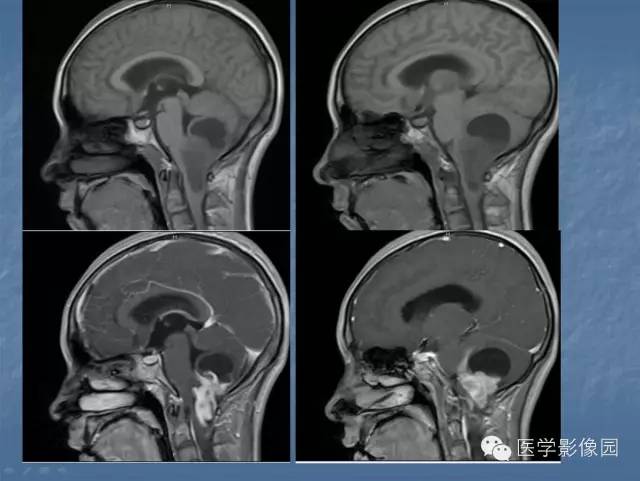 【病例】小脑毛细胞星形细胞瘤1例MR影像表现