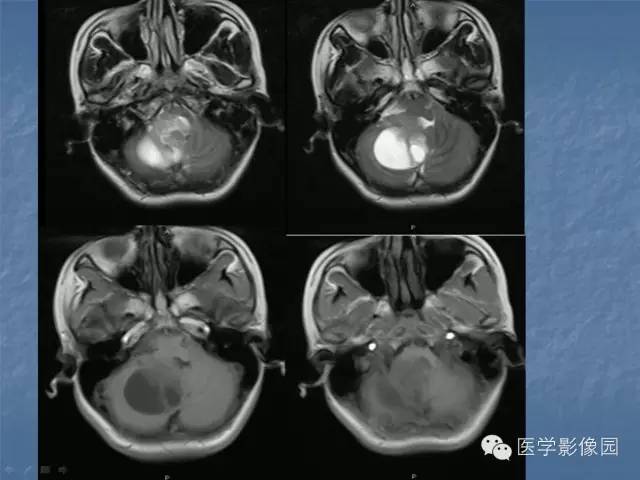 【病例】小脑毛细胞星形细胞瘤1例MR影像表现