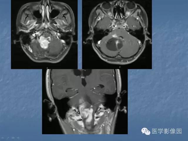 【病例】小脑毛细胞星形细胞瘤1例MR影像表现