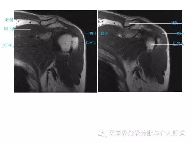 【PPT】肩关节解剖及正常MR表现