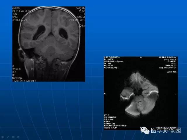 【病例】髓母细胞瘤1例MR影像表现
