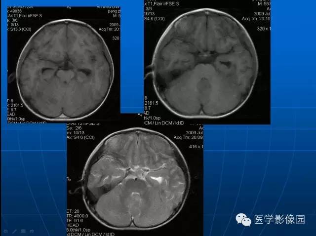 【病例】髓母细胞瘤1例MR影像表现