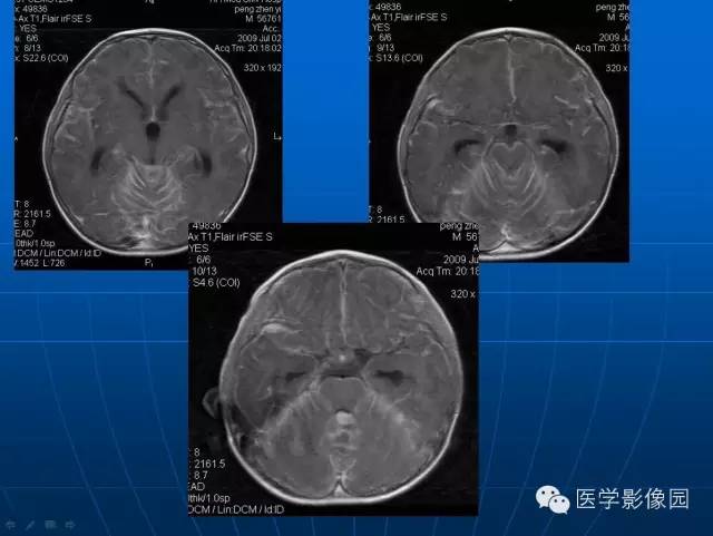 【病例】髓母细胞瘤1例MR影像表现