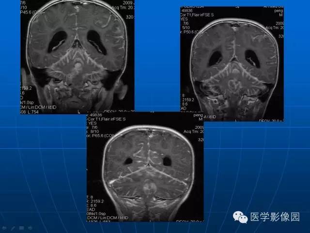 【病例】髓母细胞瘤1例MR影像表现