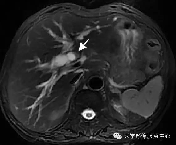 【病例】胆管癌1例MR影像表现