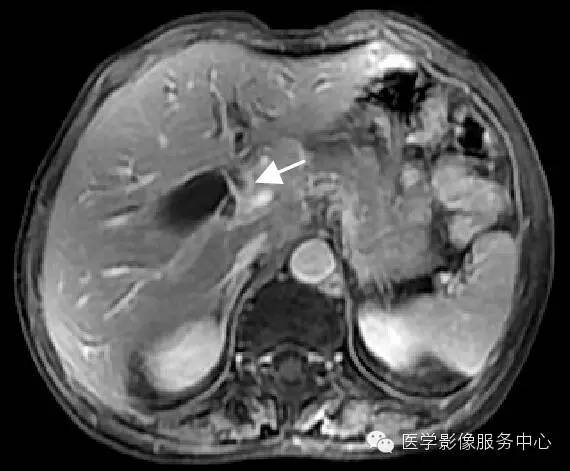 【病例】胆管癌1例MR影像表现 【病例】胆管癌1例MR影像表现