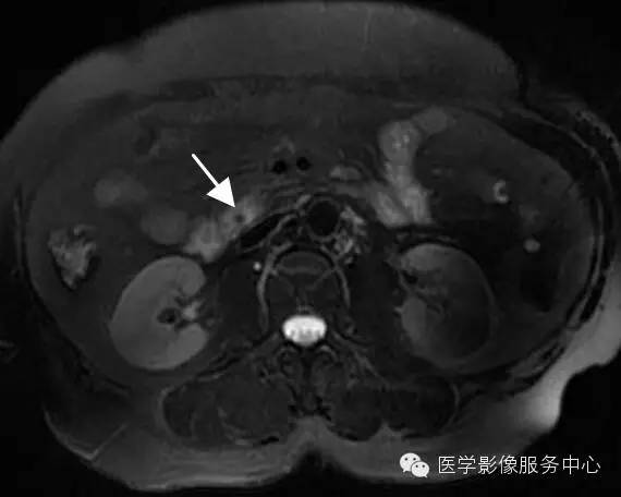 【病例】胆管癌1例MR影像表现 【病例】胆管癌1例MR影像表现